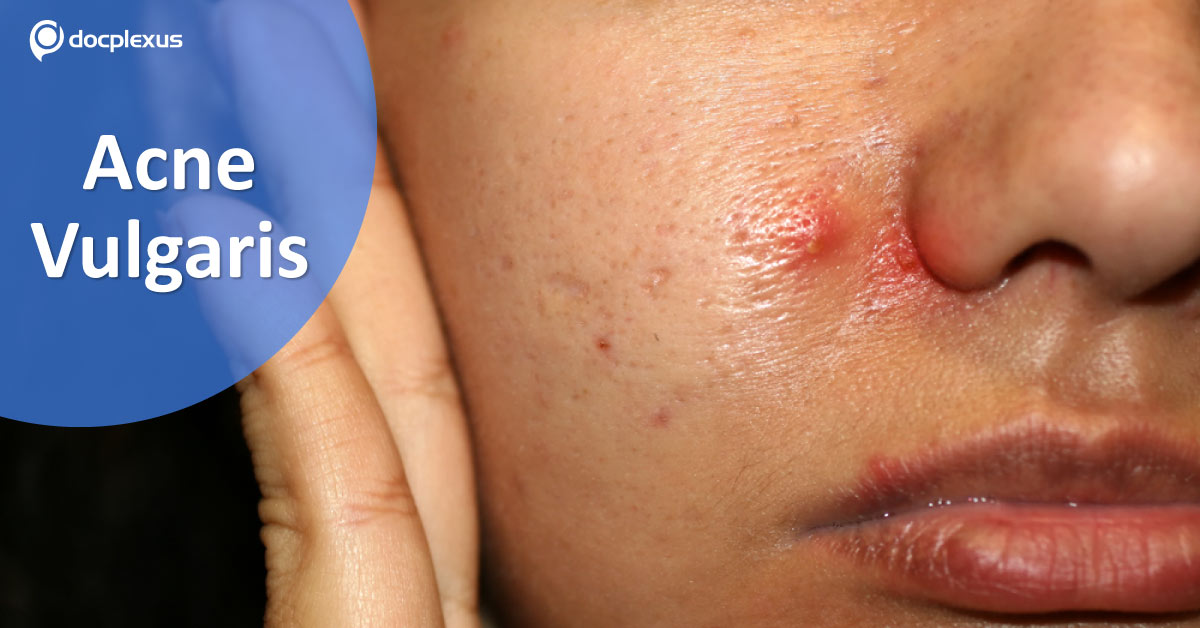 Guideline Update, Management Of Acne Vulgaris