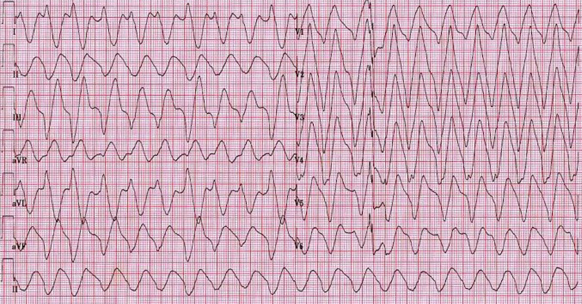 Conclude This ECG
