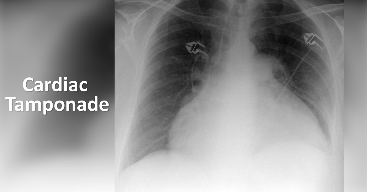 All About Complications Of Cardiac Tamponade!