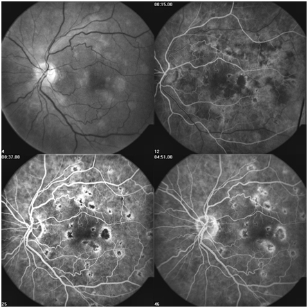 Indications Of Fundus Fluorescein Angiography