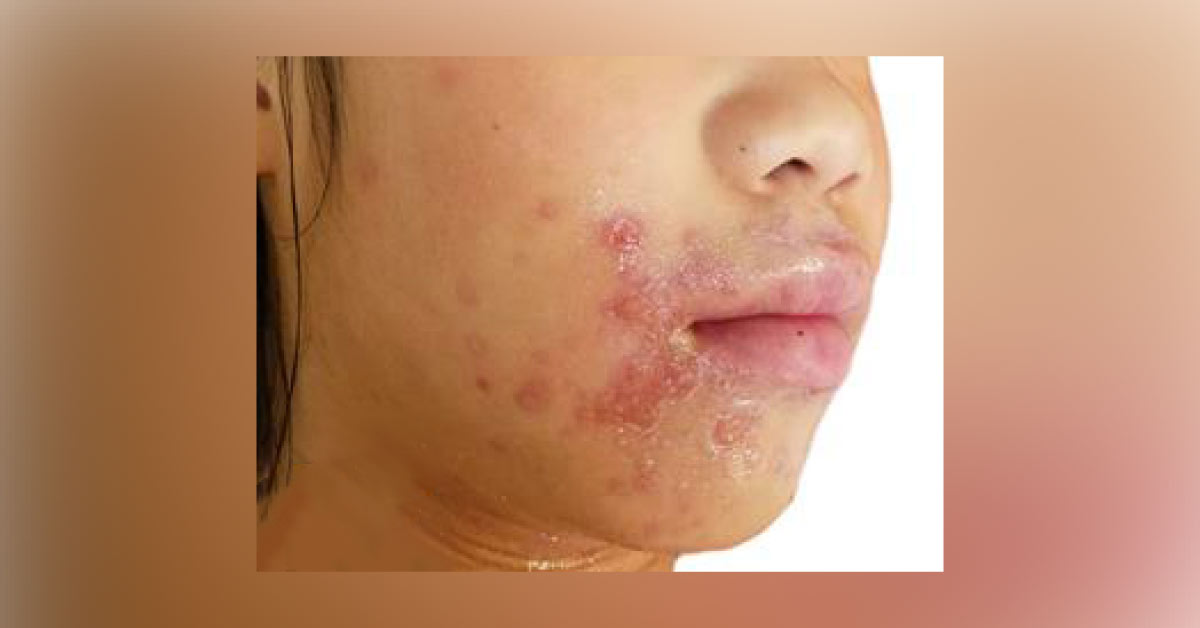 What Are These Red Sores?