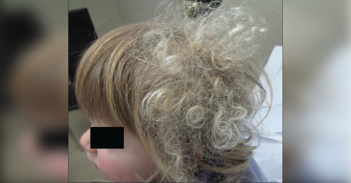 The Case Of Kinky Hair Condition