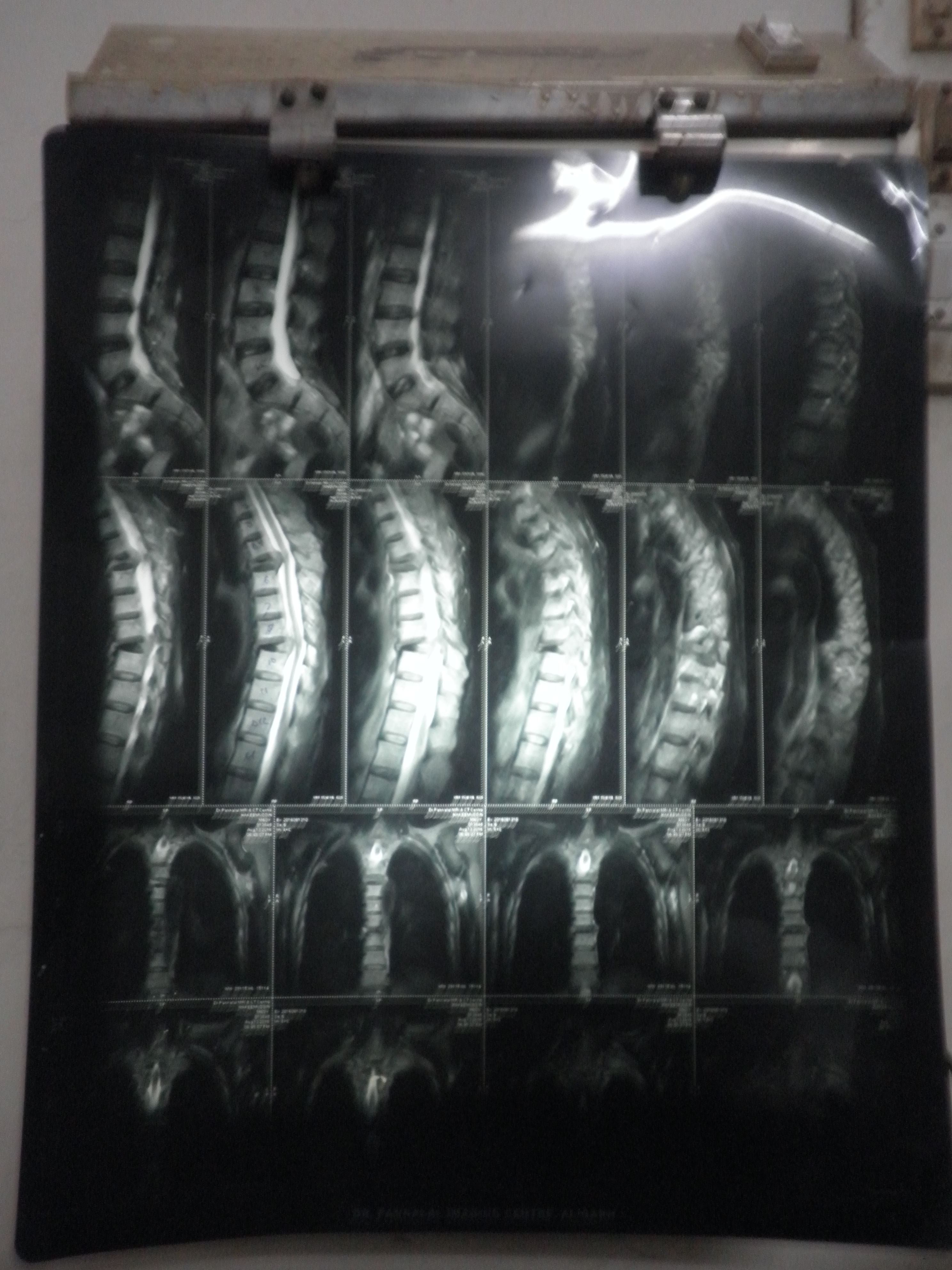 Identify And Diagnose The MRI Spine Findings