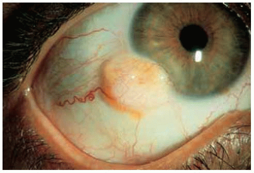 Goldenhar Syndrome Case Report In A Three Year Male Child