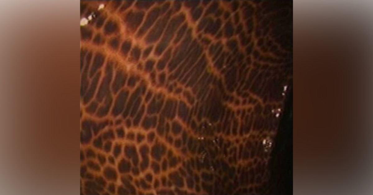 Strange ‘Cheetah’ Pattern On Colon