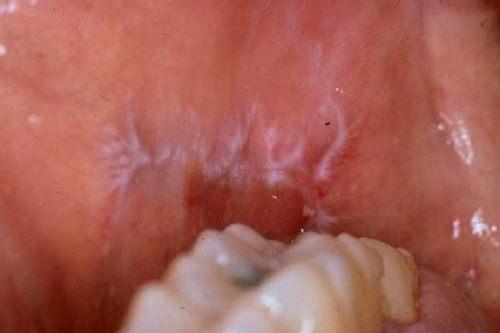 Identify This Oral Condition