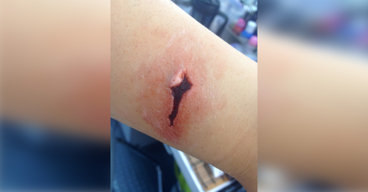 A Case Of Stab Injury