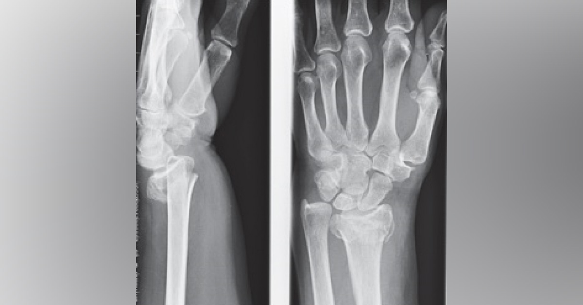 A Fall Onto The Outstretched Hand