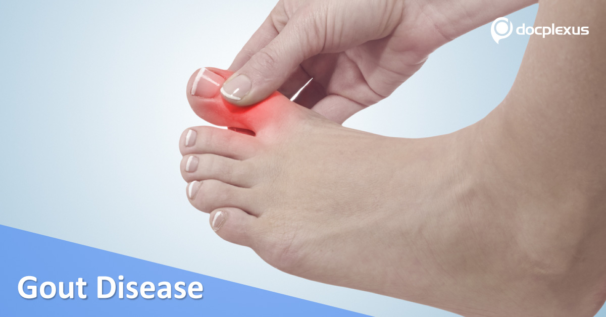 Treatment For Gout Disease