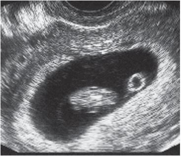 Pain In Early Pregnancy