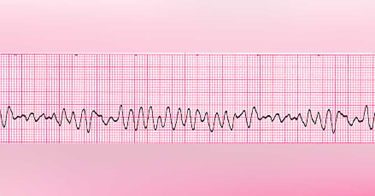 Interpret This ECG