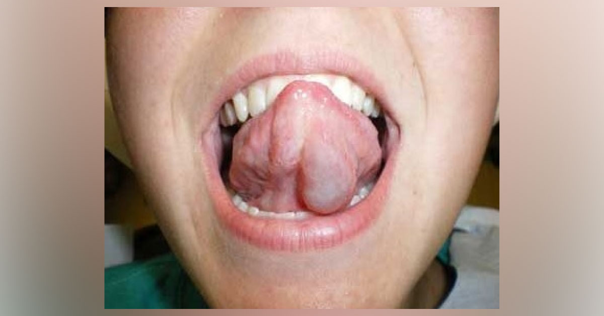 ‘’Lump’’ Under Her Tongue