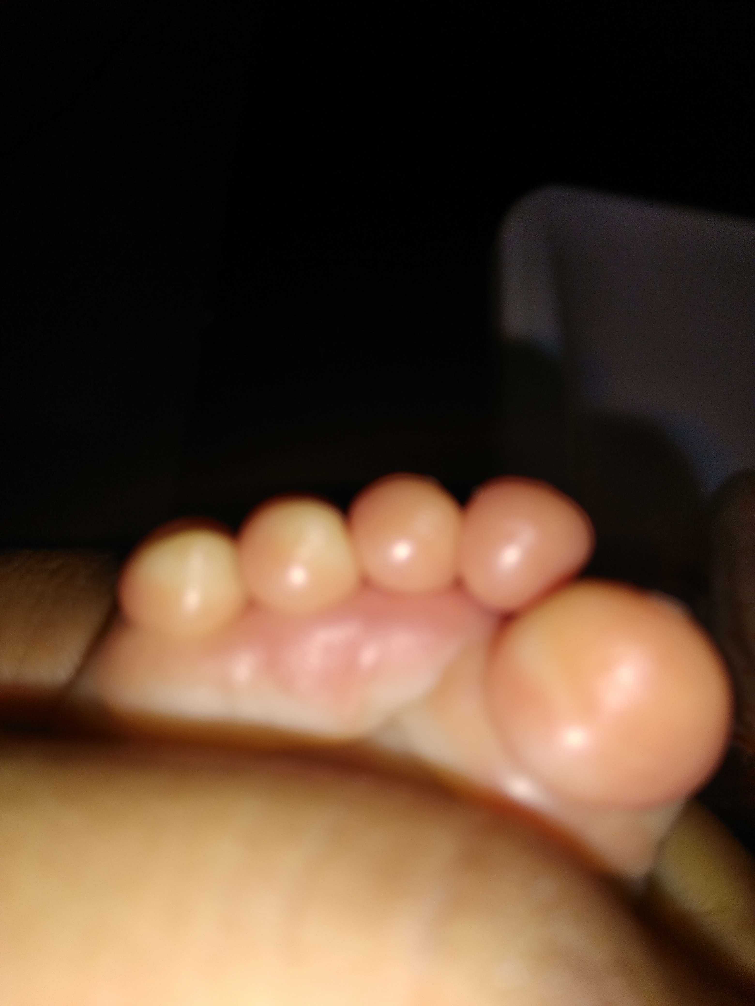  Vesicular Lesions On Fingers Of Feet