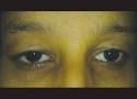 Brief Review On Ocular Manifestations Of Addison's Disease