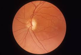 Very Brief Review On Optic Atrophy
