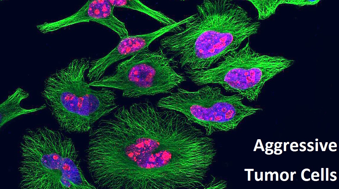 Oncology Alert: Ultrasound Can Detect Fast Growing Cancer During Surgery