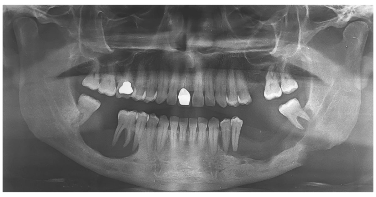 A Case of Loose Teeth and Increased Thirst