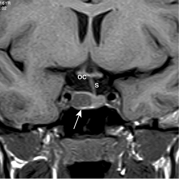Brief Review On Ocular Manifestations Of Pituitary Tumor In Cushing's Syndrome