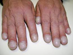 Clubbing: Causes And Mechanism