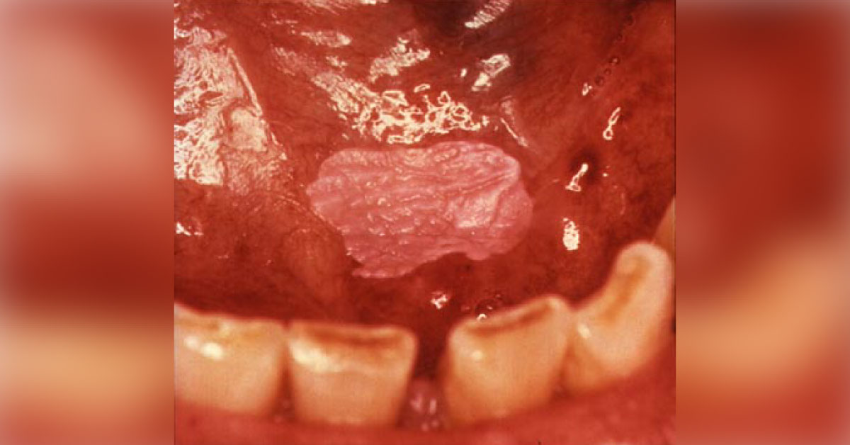 Identify This Oral Condition