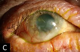 Brief Review On Complications Of Atopic Keratoconjunctivitis