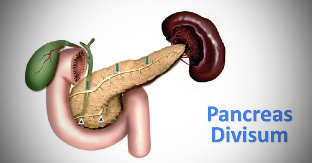 Pancreas Divisum: Diagnosis and Treatment