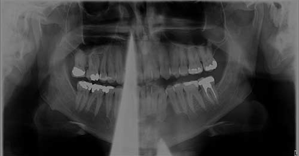 Case of a Male with Unilocular Radiolucency