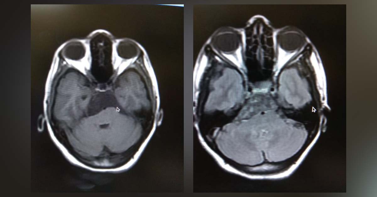 Non Contrast Study Of MRI Of Brain- Diagnose The Condition
