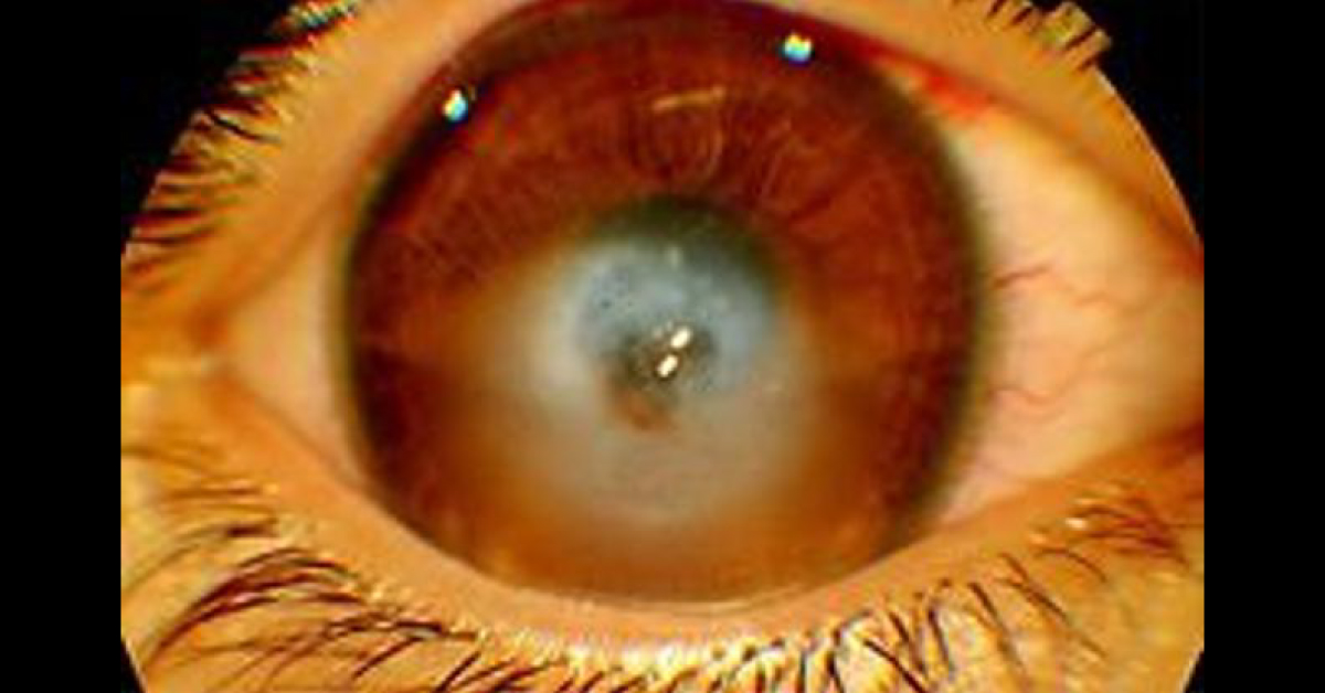 Brief Review On Cornea Hydrops