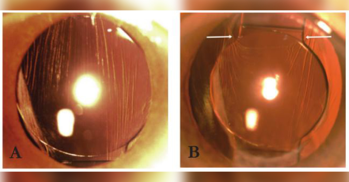 Brief Review On Potential Complications Of Cataract Surgery