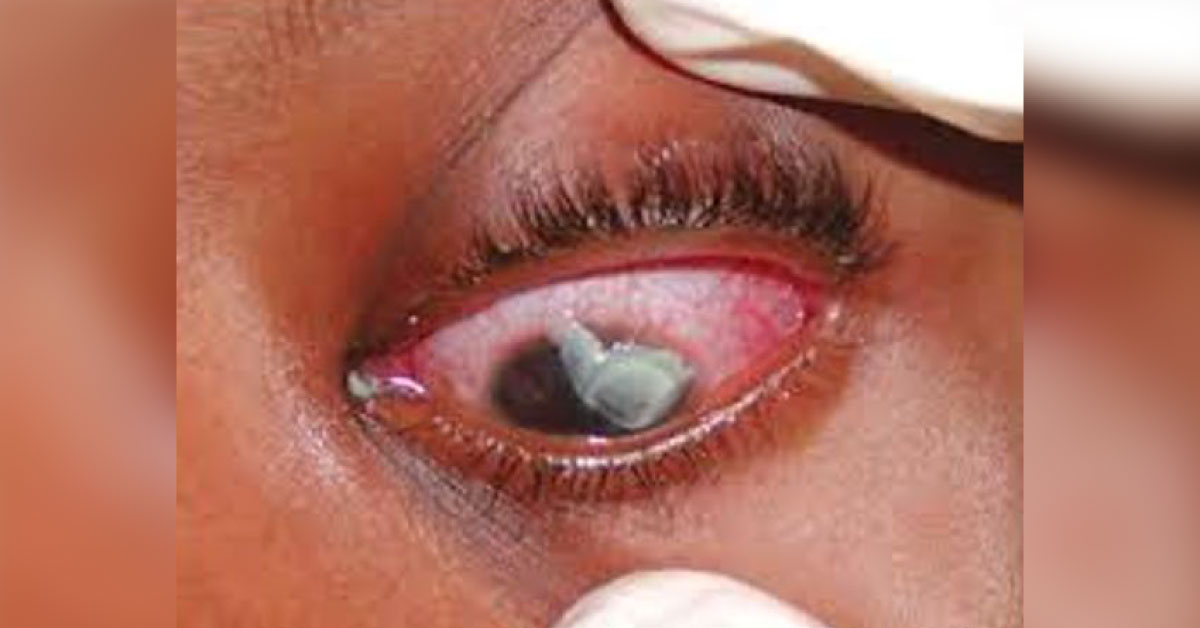 Brief Revew On Ocular Manifestations Of Tetanus