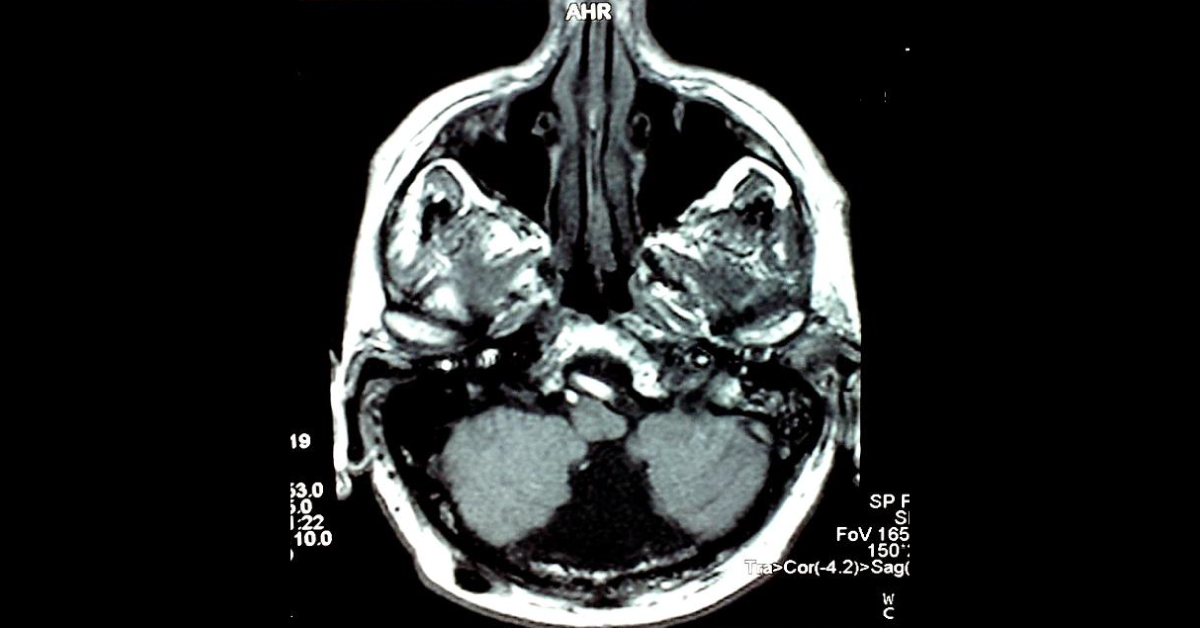 Brief Review On Ocular Signs Of Cerebellar Disorders