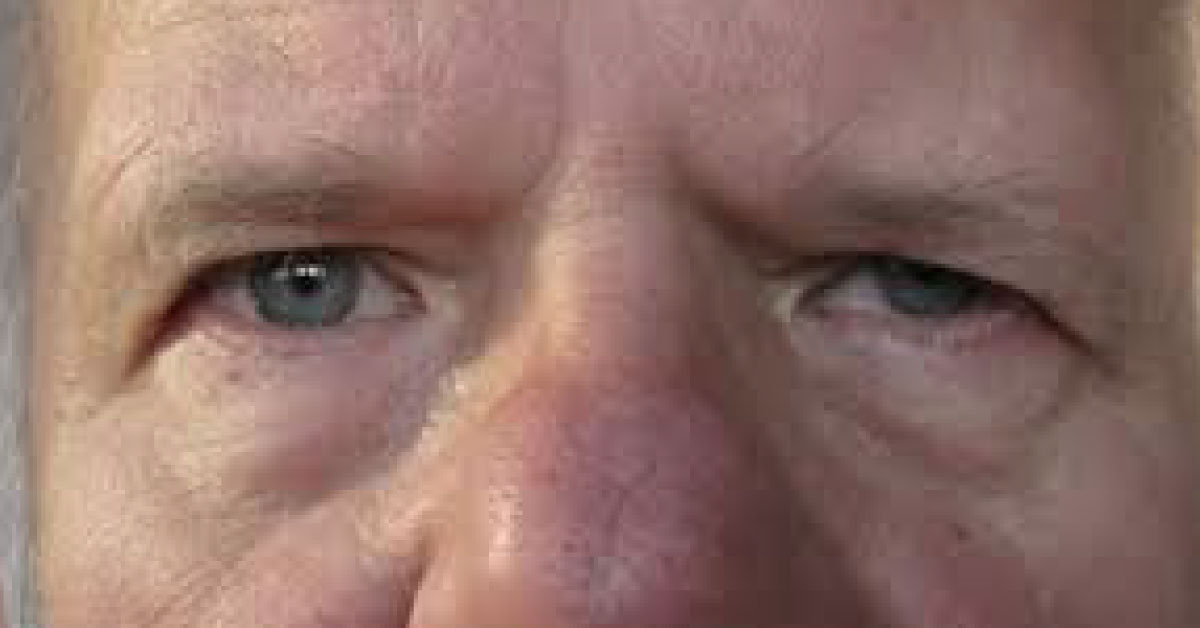 Brief Review On Ocular Manifestations Of Myotonic Dystrophy