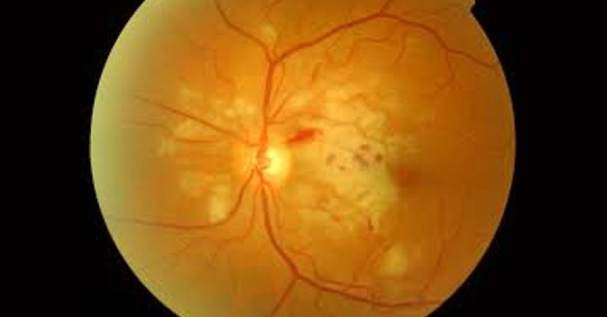 Brief Review Of Purtschers Retinopathy Associated With A Pancretits