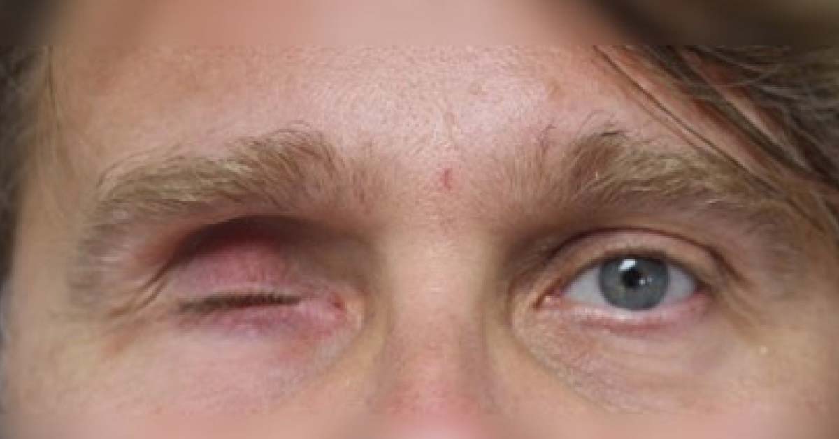 Brief Review On Indications Of Evisceration