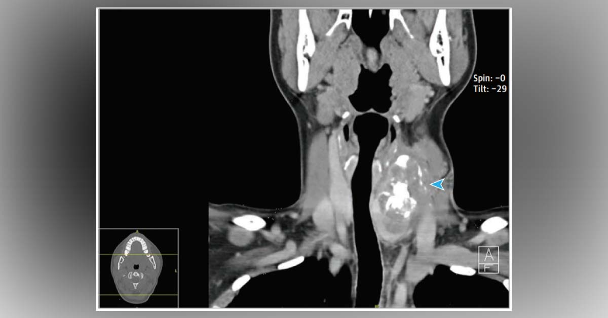 Can You Solve This Case of a Painless Neck Mass?
