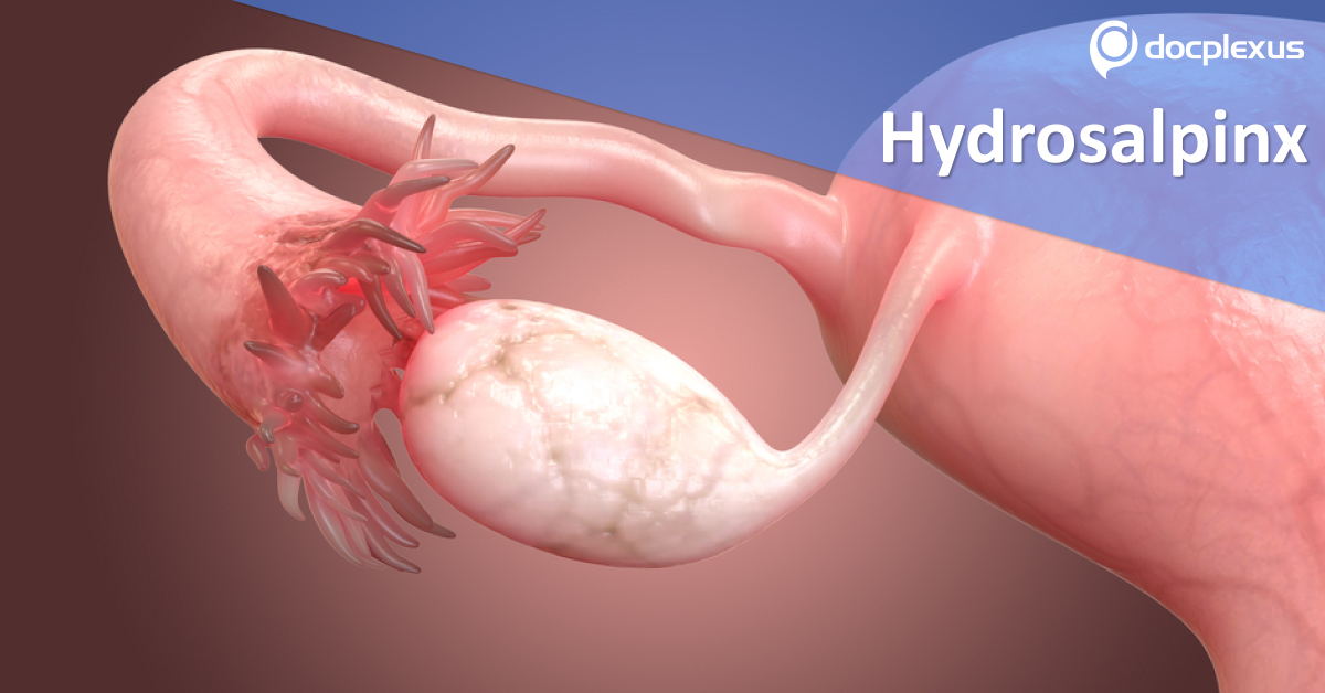Hydrosalpinx: Management Options Before IVF