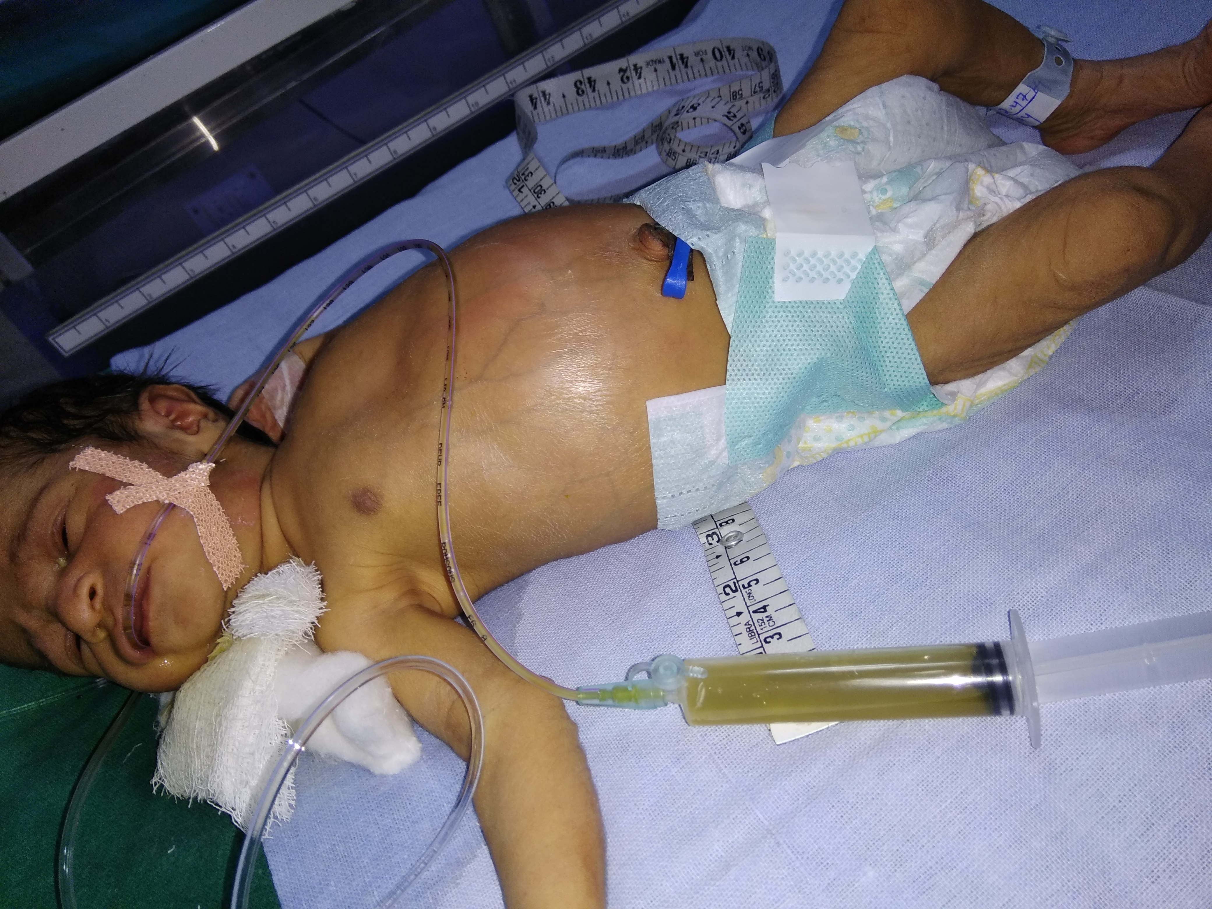 Distention Of Abdomen