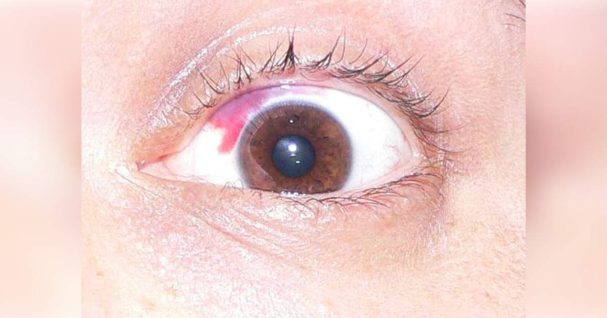 Brief Review On Ocular Manifestations Of Subarachnoid Hemorraghe