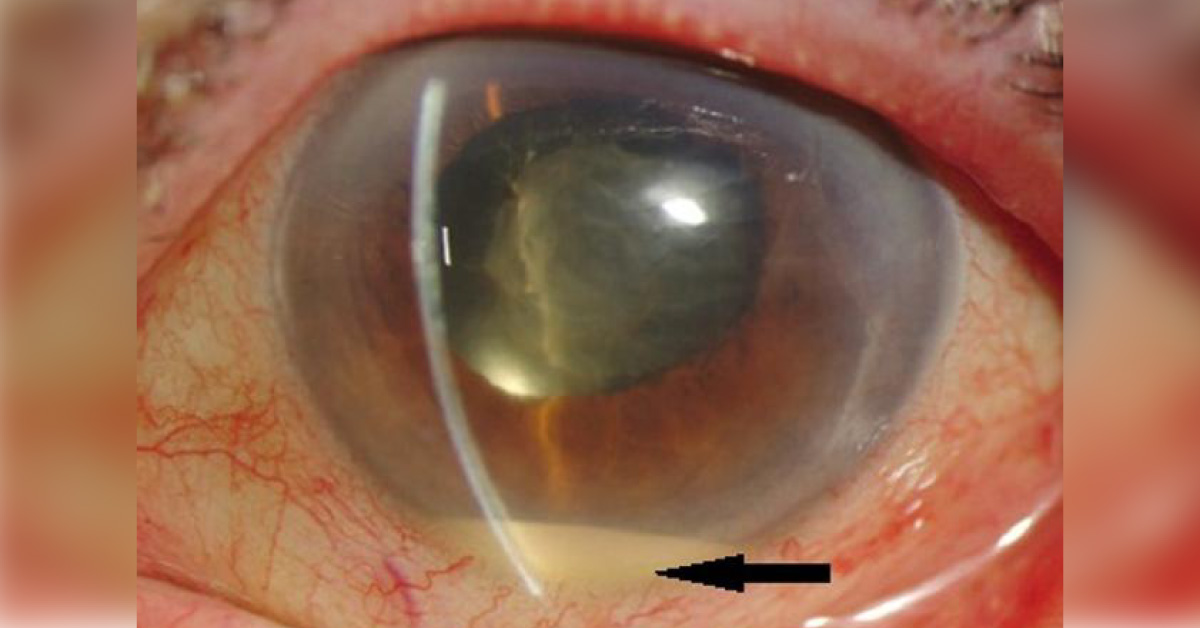 Brief Review On Endophthalmitis