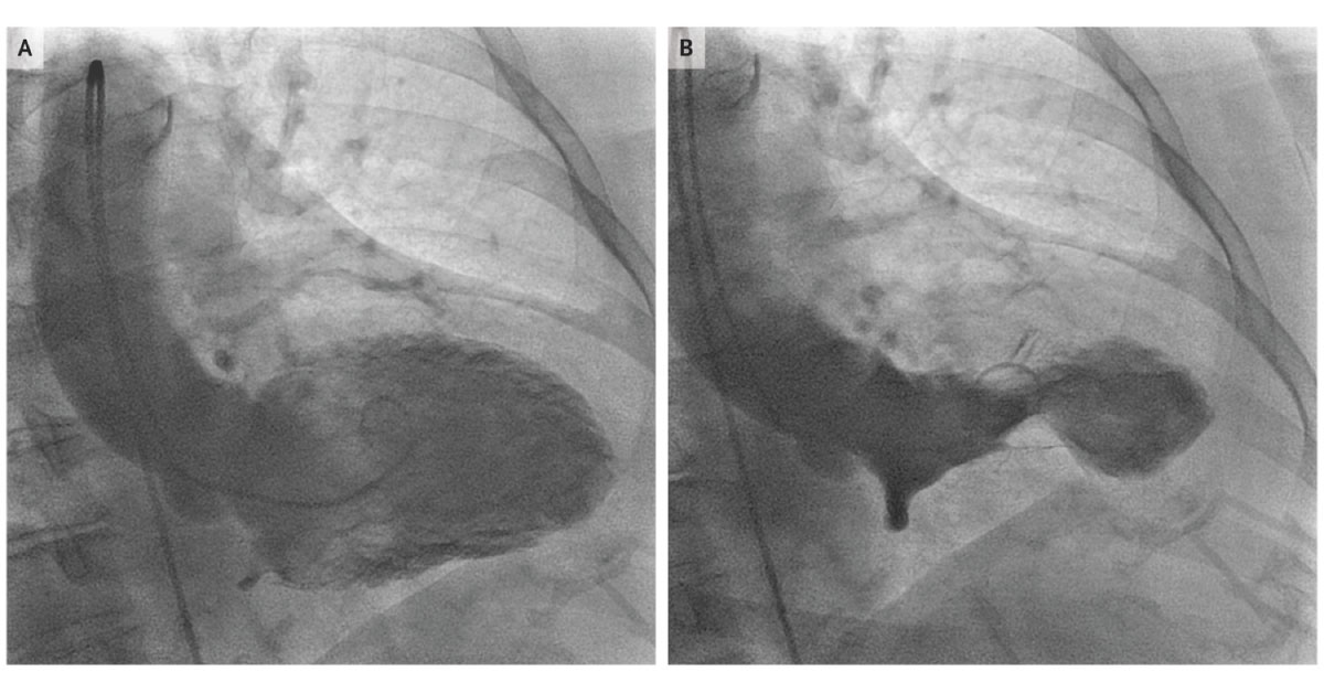 An Old Woman With Severe Chest Pain
