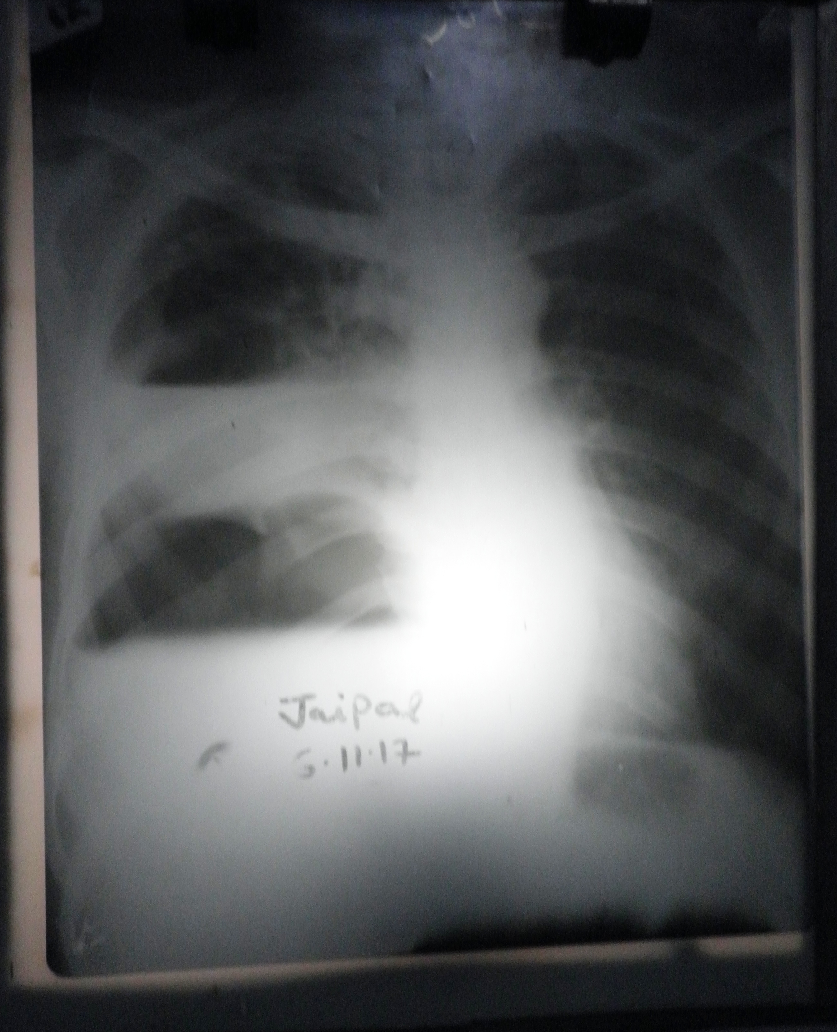 Identify The Findings Of X-ray Chest Paview 1