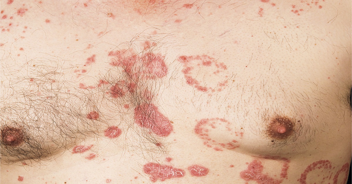 Lesions in a Psoriasis Patient
