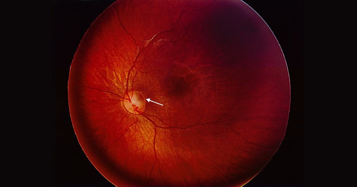 Case of Misaligned Eyes