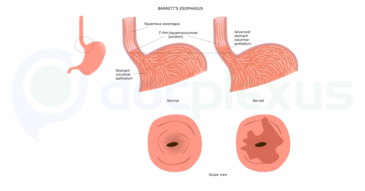 Quick Swallowable Test To Diagnose Barrett's Oesophagus Than Endoscopy