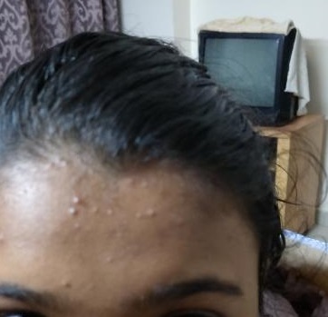 Diagnose The Eruption On Forehead Skin