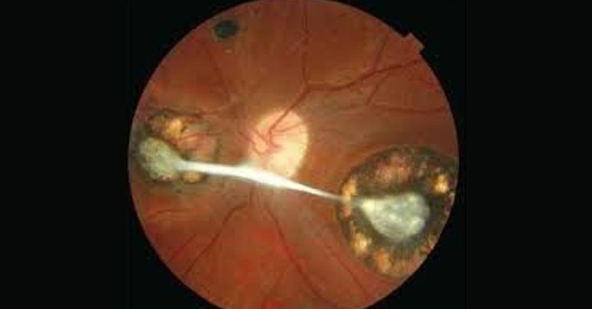 Brief Review Of Ocular Manifestations Of Congenital Toxoplasmosis