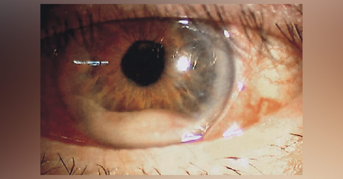 Brief Review On Ocular Manifestations Of Multiple Myeloma