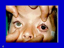 Brief Review On Shaken Baby Syndrome