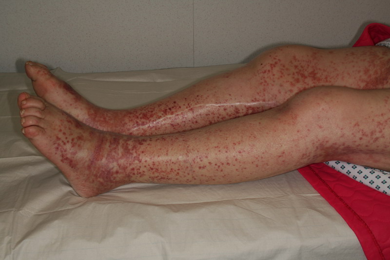 Diagnose The Lesion In This Adolescent Boy